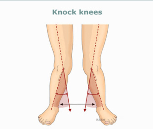 Chart of knock Knees