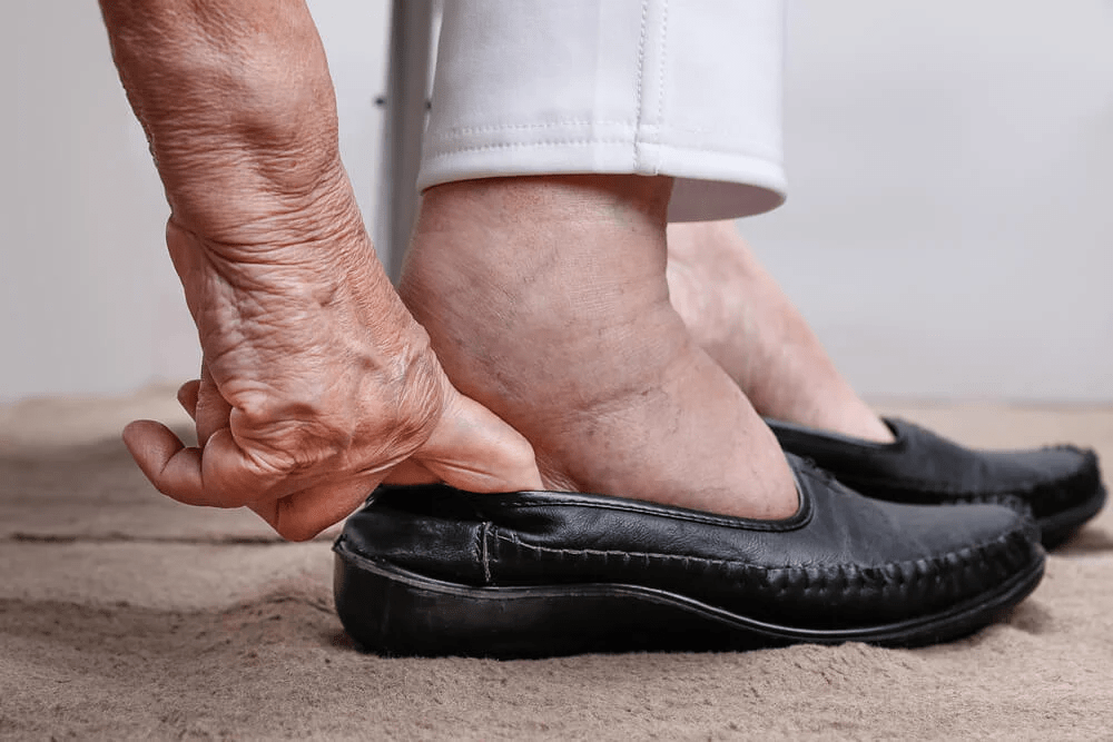 An old man has swelling feet wearing shoes